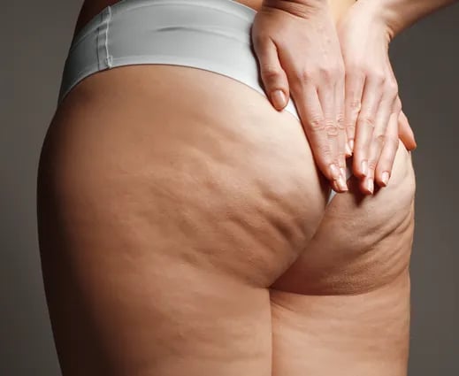 All the Facts About Cellulite - Shea Aesthetic Clinic