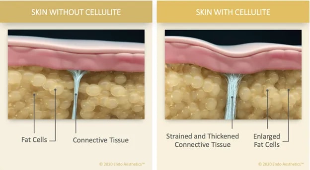 What is cellulite and how to minimise its appearance? - UpCircle Beauty