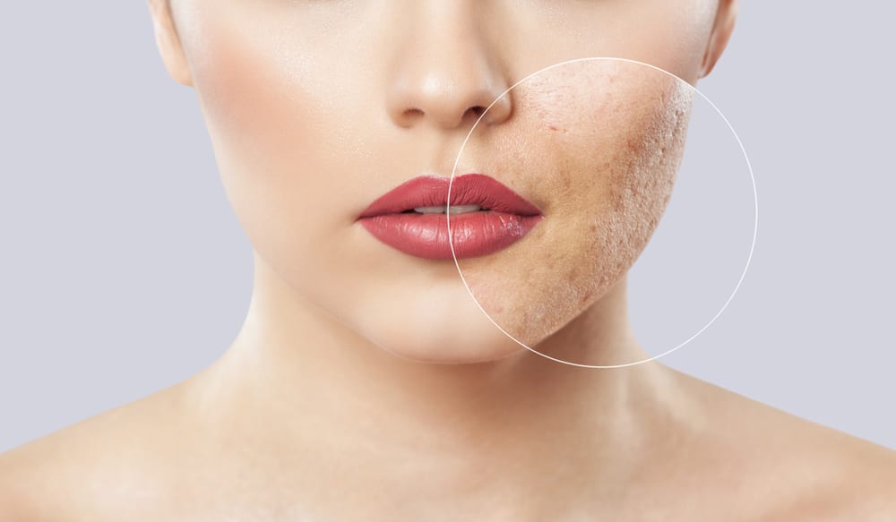 Skin Resurfacing | Shea Aesthetic Clinic
