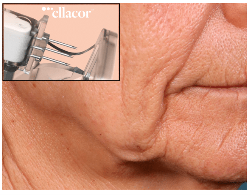 Close up of womans face / ellacor device