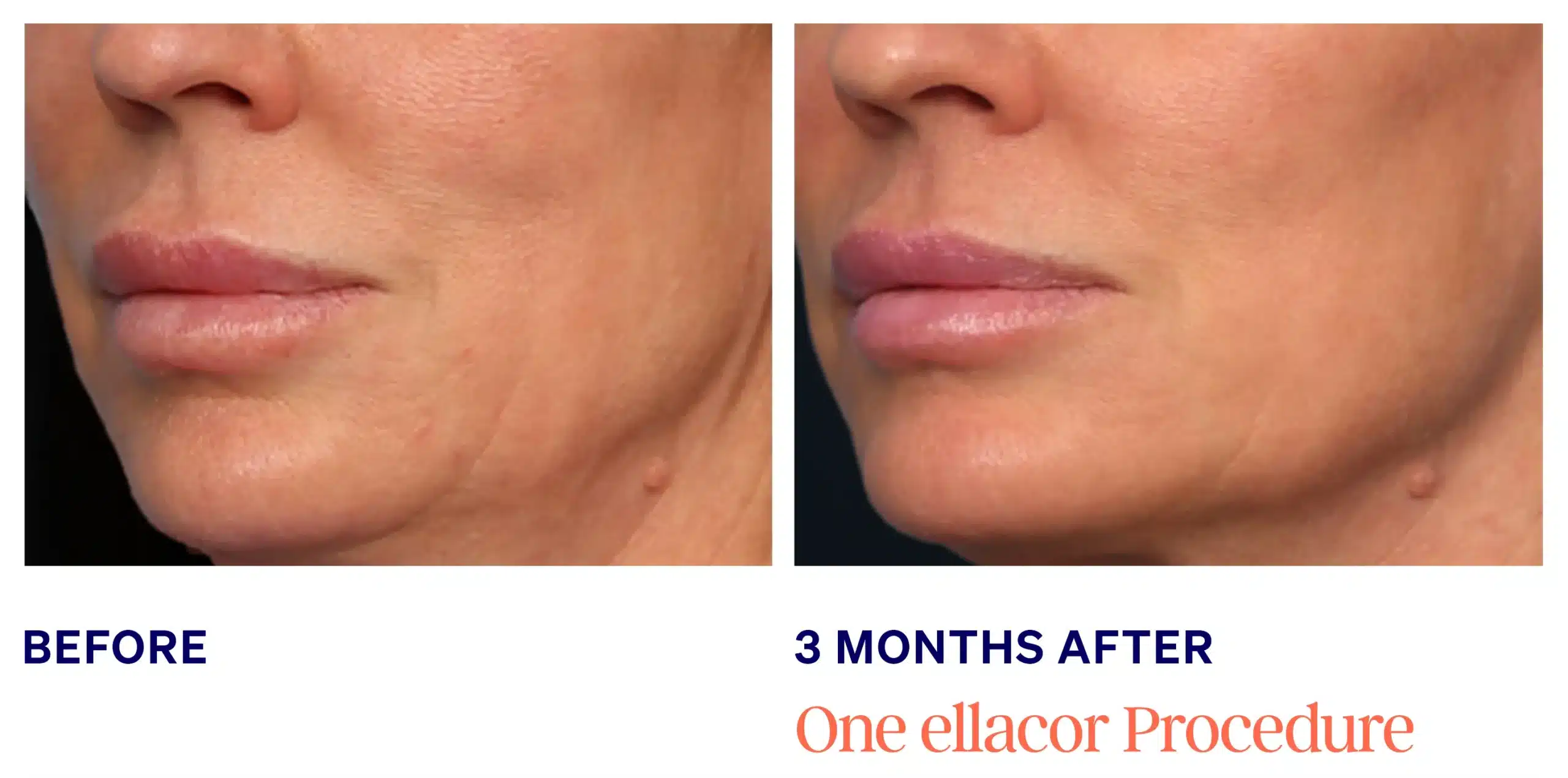 Ellacore in Knoxville skin tightening female face before and after picture 1