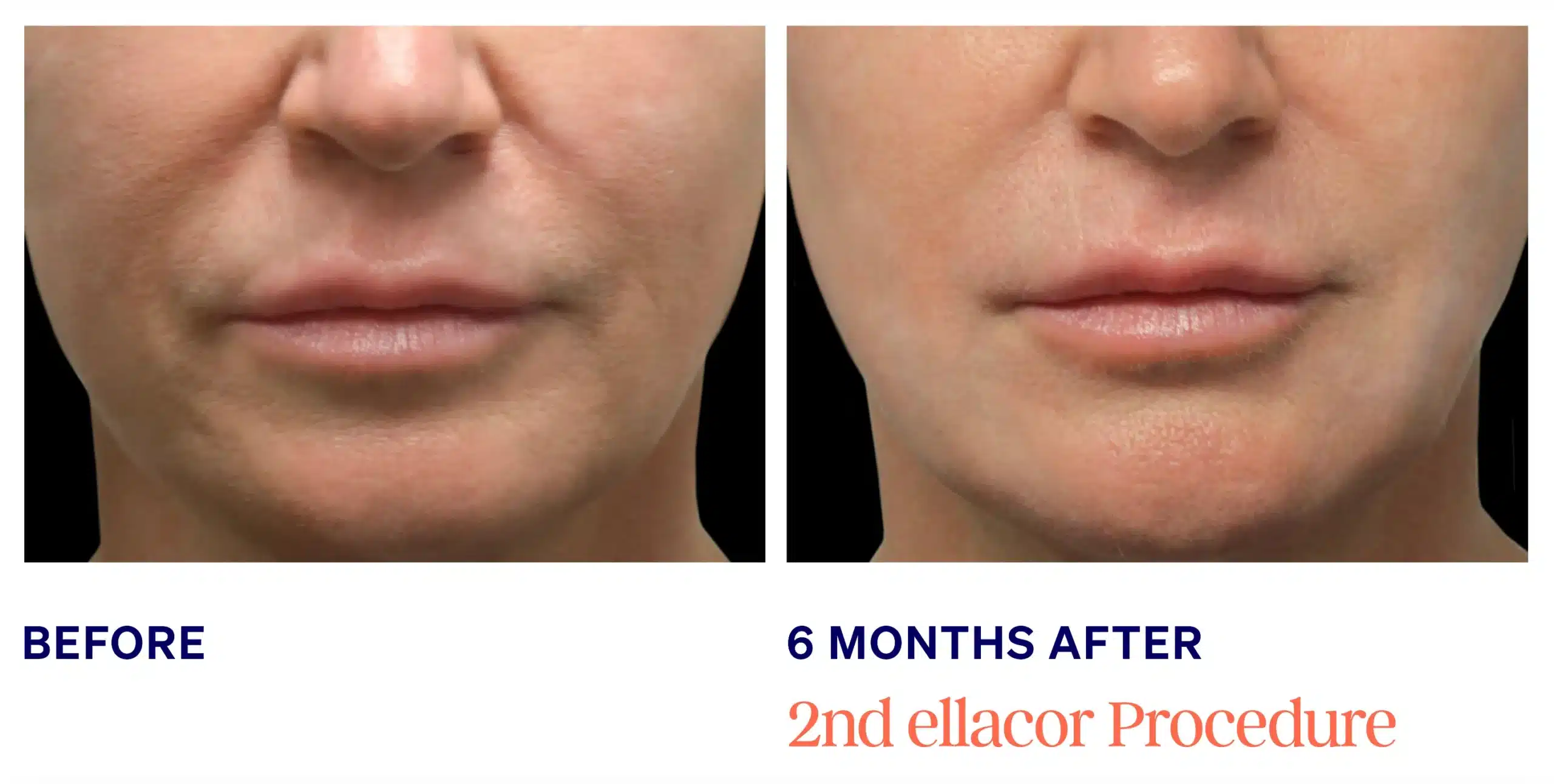 Ellacore in Knoxville skin tightening female face before and after picture 2