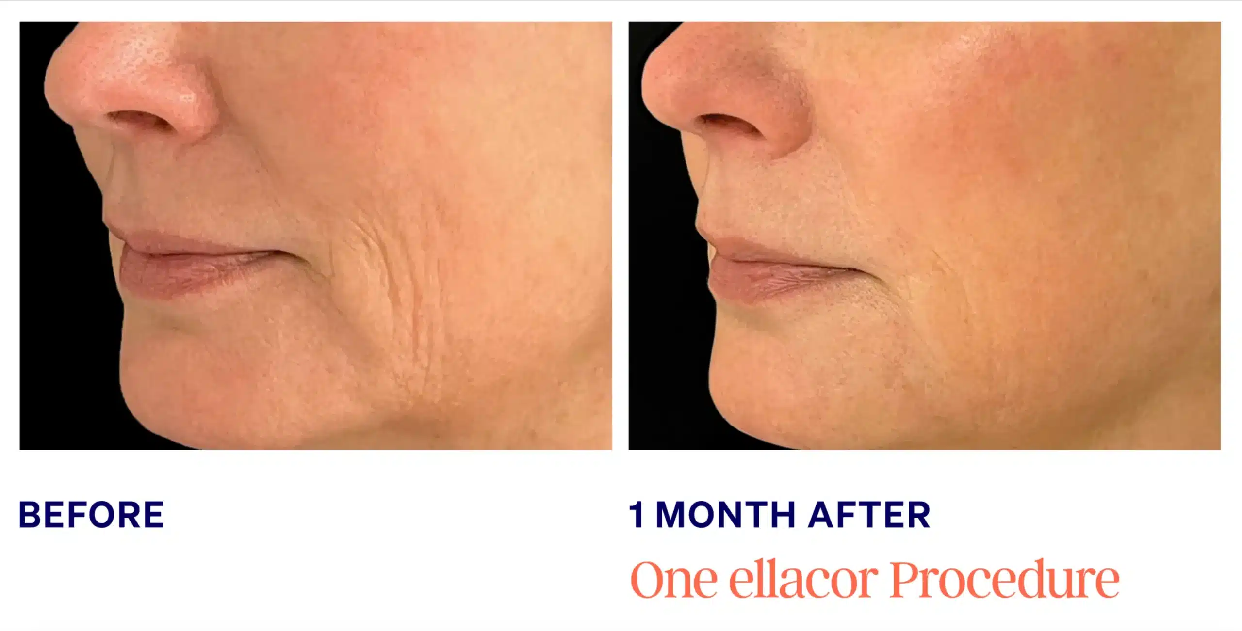 Ellacore in Knoxville skin tightening female face before and after picture 4