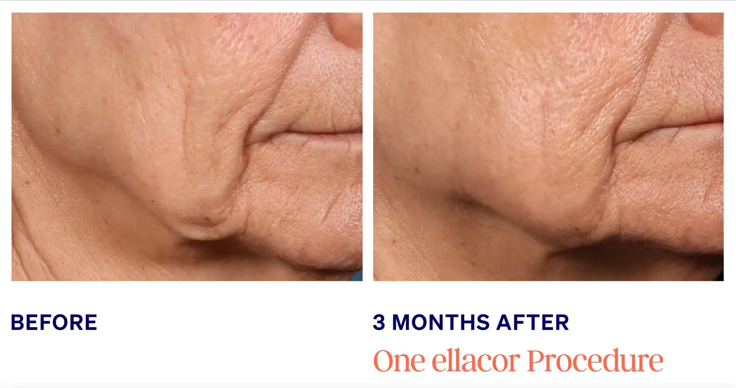Ellacore in Knoxville skin tightening male face before and after picture 3