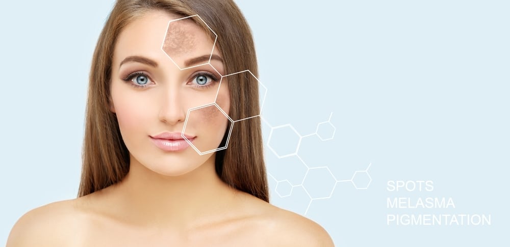 Hyperpigmentation | Shea Aesthetic Clinic