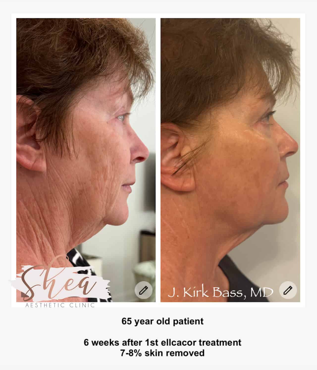 Micro-coring before and after results in Knoxville Oak Ridge Shea Aesthetic Clinic 3