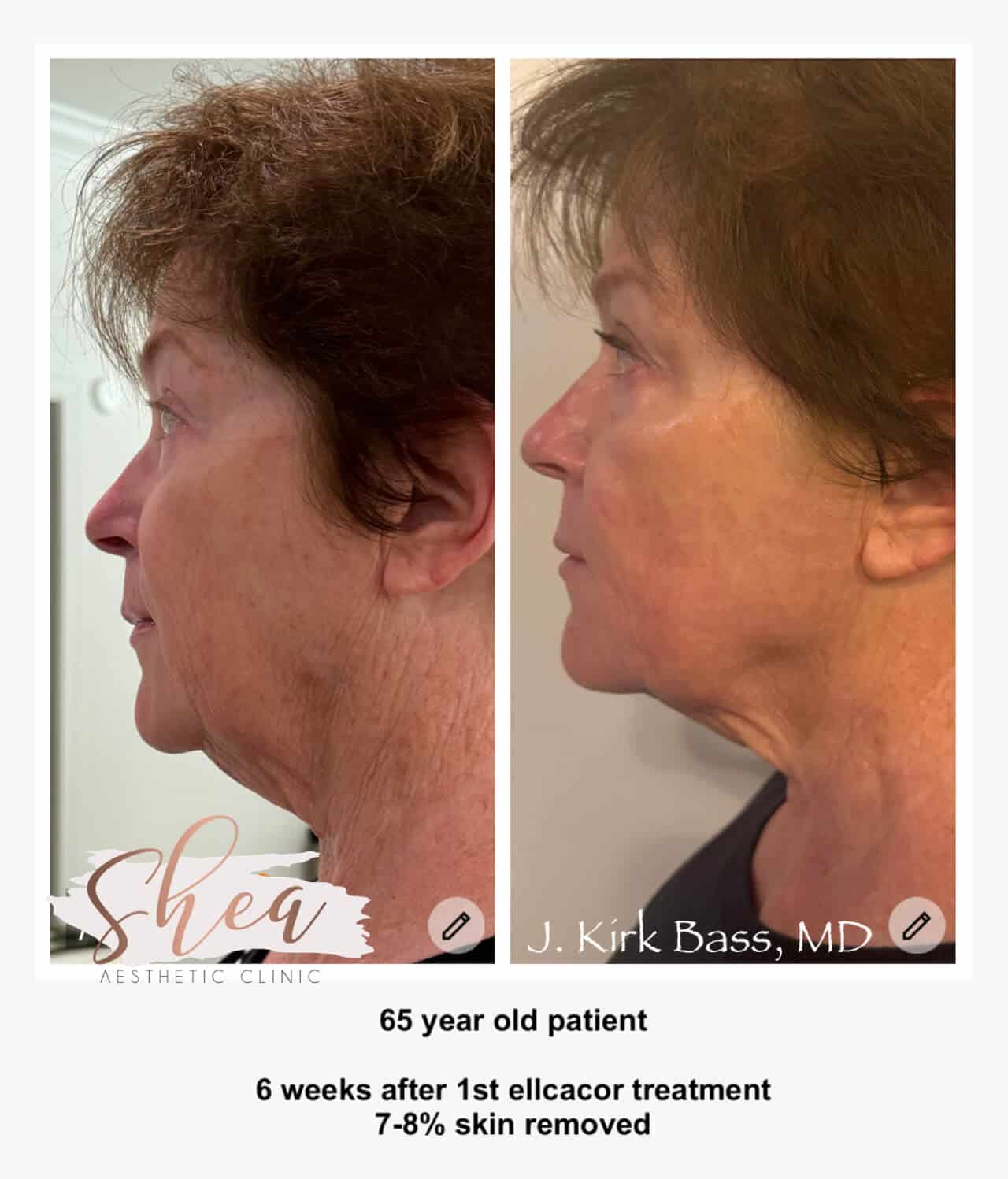 Micro-coring before and after results in Knoxville Oak Ridge Shea Aesthetic Clinic 4