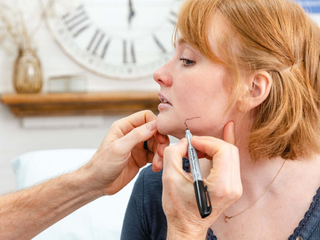 Dr. Bass uses a washable marker to demarcate where he plans to apply treatment on a patient's cheek as part of her non-surgical excess skin removal in Oak Ridge.