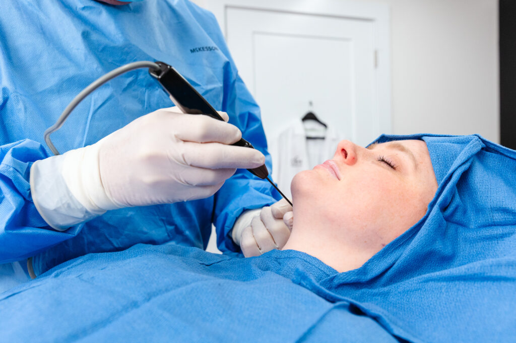 A patient lies down with a cannula inserted underneath her skin for Quantum RF body contouring near Hardin Valley.