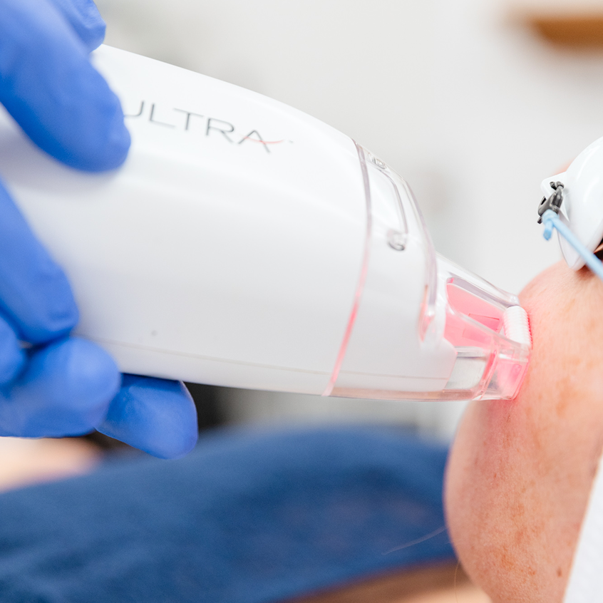 A close-up of a provider at Shea Aesthetic Clinic applying the LaseMD Ultra device to a patient's face for acne scar treatment in Oak Ridge.