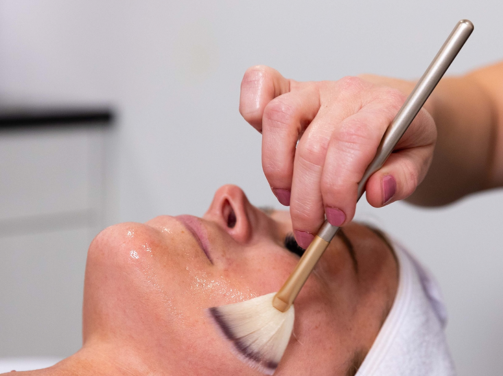 A Shea aesthetician applies a facial peel to a patient's face during an acne scar treatment in Oak Ridge.