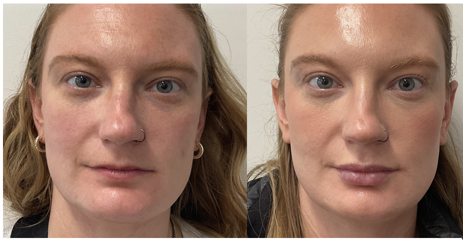 A patient enjoys fuller lips after receiving lip filler near Oak Ridge.