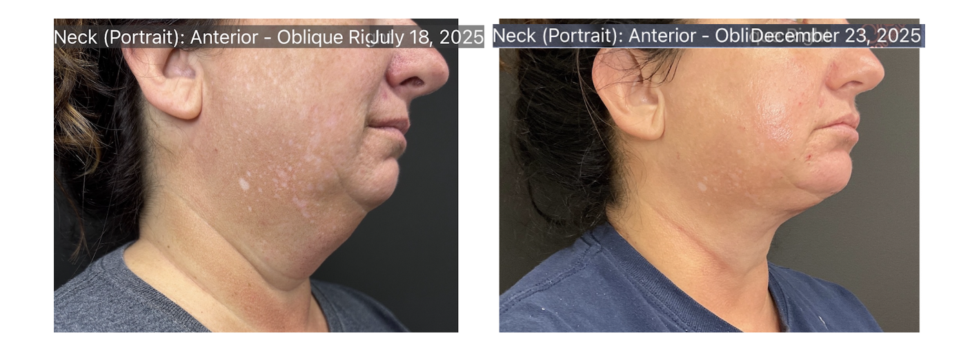 A patient enjoys a more lifted, contoured neck and jawline after targeted body sculpting near Knoxville. 
