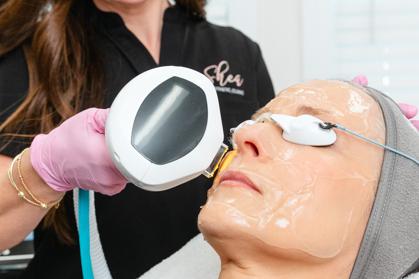 A Shea provider administers an IPL photofacial as part of a patient's plan for facial contouring near Knoxville.