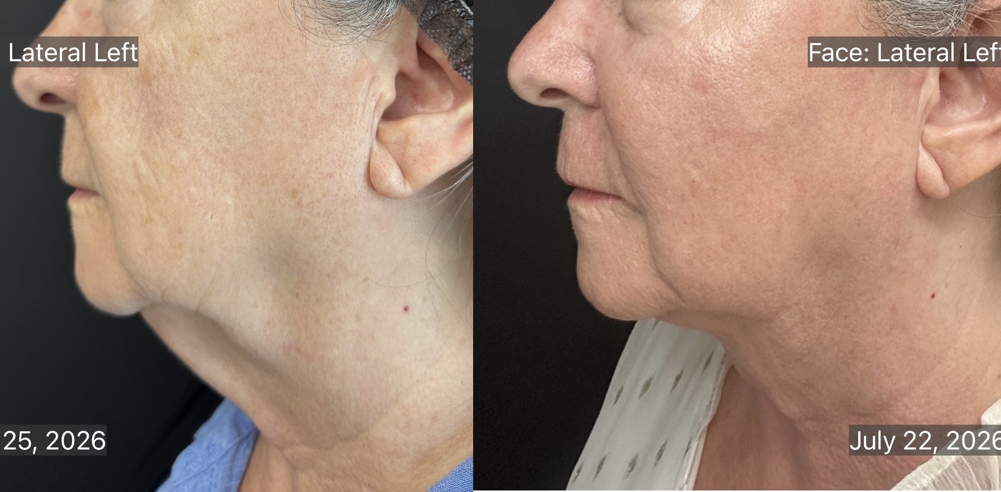 Radiofrequency assisted Liposuction and ellacor for double chin and jowl before and after 1 month